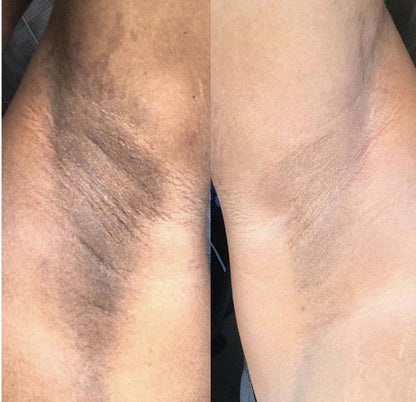 SmoothGlow™ Ingrown Hair & Soothing Serum – 1+1 FREE