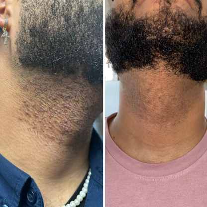 SmoothGlow™ Ingrown Hair & Soothing Serum – 1+1 FREE