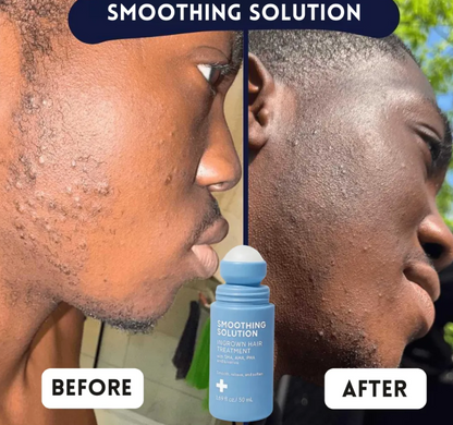SmoothGlow™ Ingrown Hair & Soothing Serum – 1+1 FREE