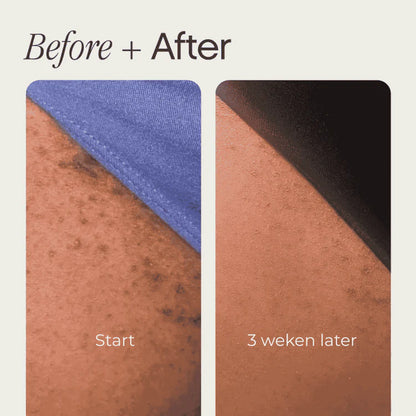 SmoothGlow™ Ingrown Hair & Soothing Serum – 1+1 FREE