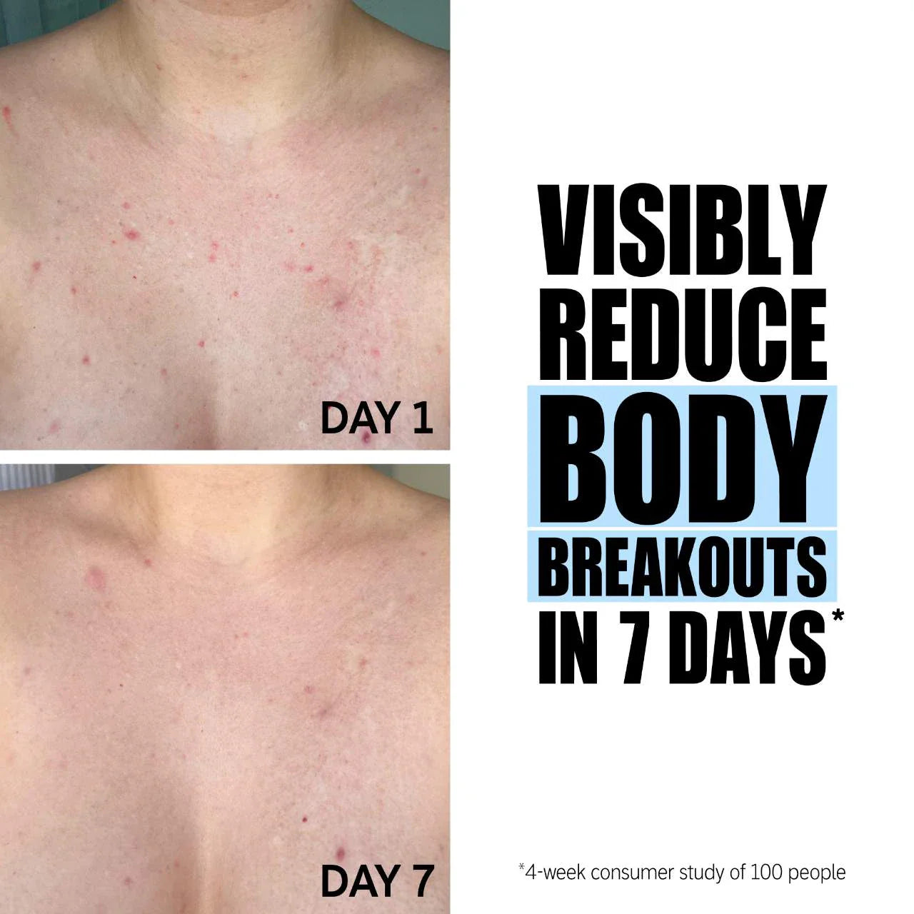 SmoothGlow™ Ingrown Hair & Soothing Serum – 1+1 FREE