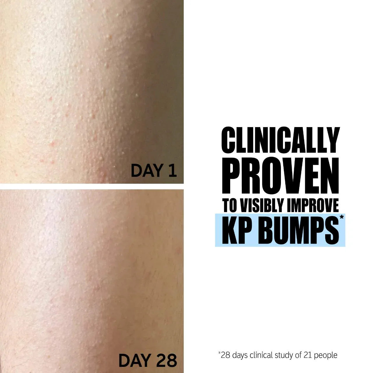 SmoothGlow™ Ingrown Hair & Soothing Serum – 1+1 FREE