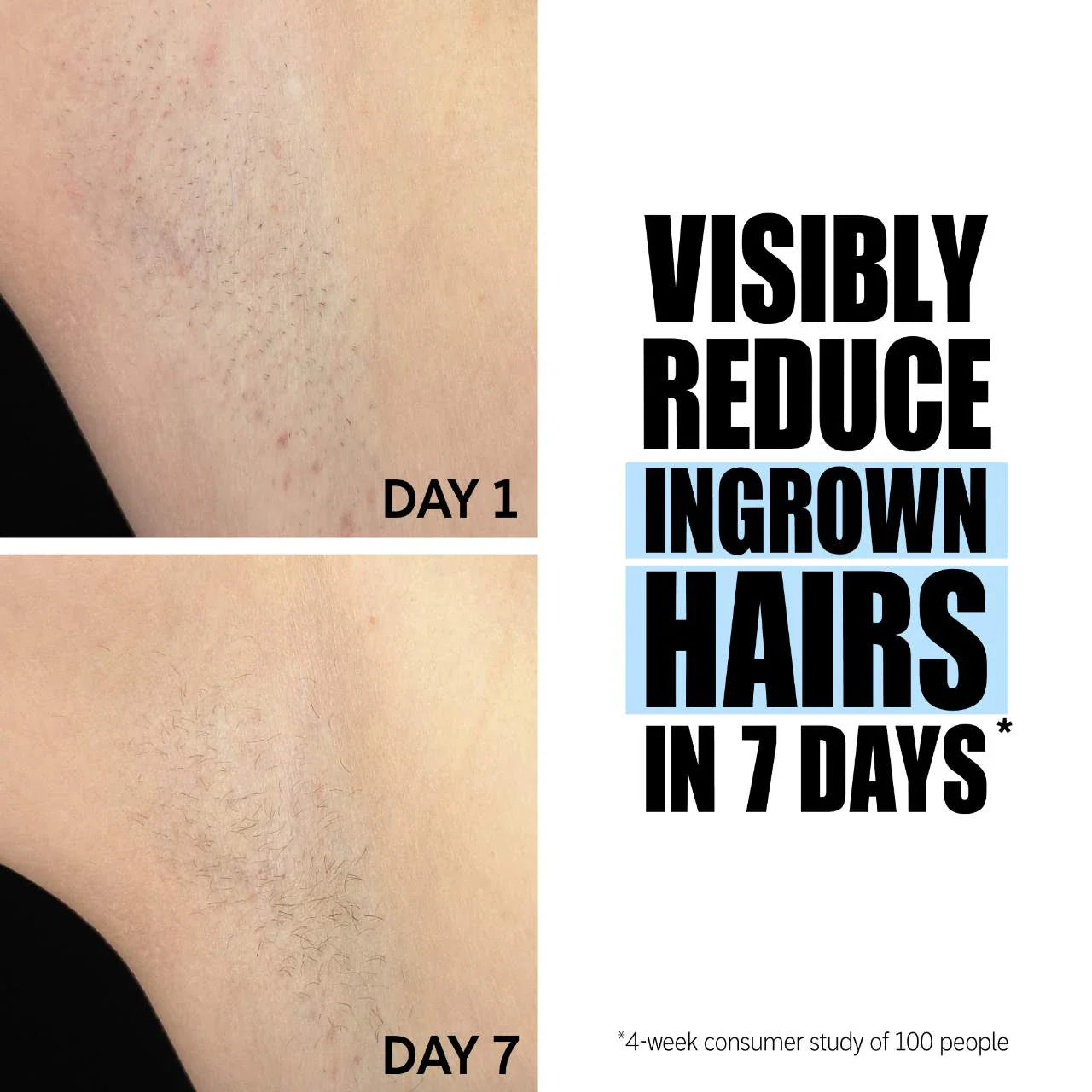 SmoothGlow™ Ingrown Hair & Soothing Serum – 1+1 FREE